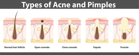 Formation d'un bouton d'acné